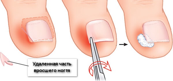 เล็บเท้าคุด สาเหตุของลักษณะอาการการรักษาโดยไม่ต้องผ่าตัดด้วยวิธีการรักษาพื้นบ้านขี้ผึ้งการผ่าตัด