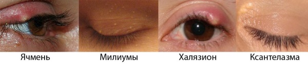 Wie man wen auf den Augenlidern mit Volksheilmitteln, Salben loswird. Ursachen für weißes, gelbes Xanthelasmus