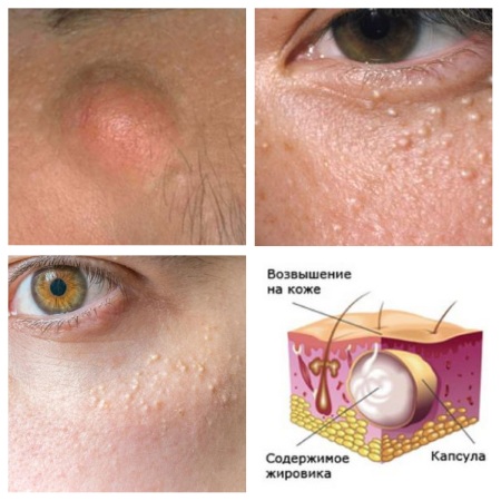 How to get rid of wen on the eyelids with folk remedies, ointments. Causes of white, yellow xanthelasm