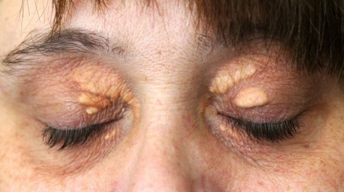 Wie man wen auf den Augenlidern mit Volksheilmitteln, Salben loswird. Ursachen für weißes, gelbes Xanthelasmus