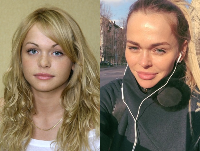 Anna Khilkevich sebelum dan selepas pembedahan plastik, tinggi badan, berat badan, parameter badan. Foto, biografi