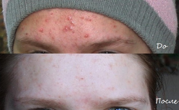 Baziron AS. Mga tagubilin para sa paggamit para sa acne, presyo, analogs, pagsusuri ng mga dermatologist