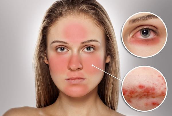 Baziron AS. Instructies voor gebruik voor acne, prijs, analogen, beoordelingen van dermatologen