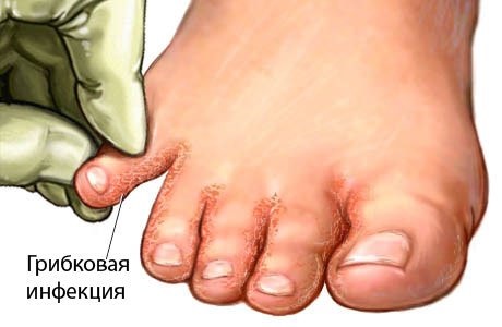 Comment se débarrasser efficacement des odeurs de pieds. Meilleurs remèdes dans les pharmacies, causes et traitements de la transpiration
