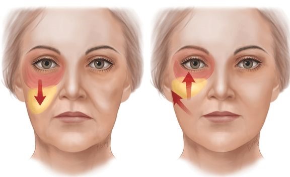 كيفية إزالة التقلبات على الوجه واستعادة الشكل البيضاوي: التدريبات والإجراءات في التجميل والجمباز والشد