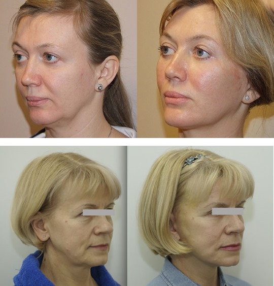 كيفية إزالة التقلبات على الوجه ، واستعادة الشكل البيضاوي: التمارين ، والإجراءات في التجميل ، والجمباز ، ورفع