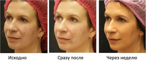 Come rimuovere i volatili sul viso, ripristinare l'ovale: esercizi, procedure in cosmetologia, ginnastica, rassodamento