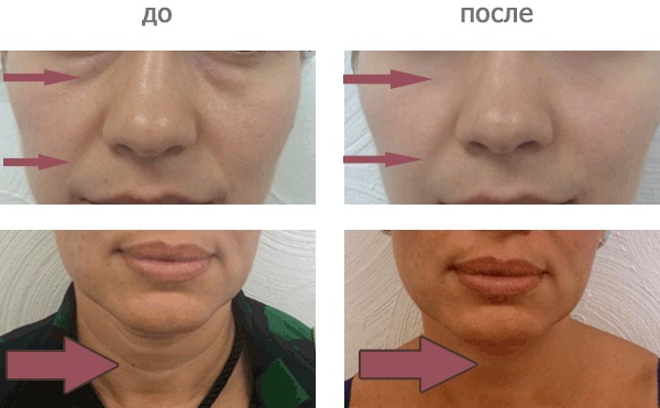 Carboxytherapie - wat is het voor een gezicht in de cosmetologie: niet-injectie, niet-invasief, injectie. Voor en na foto's, prijs, recensies