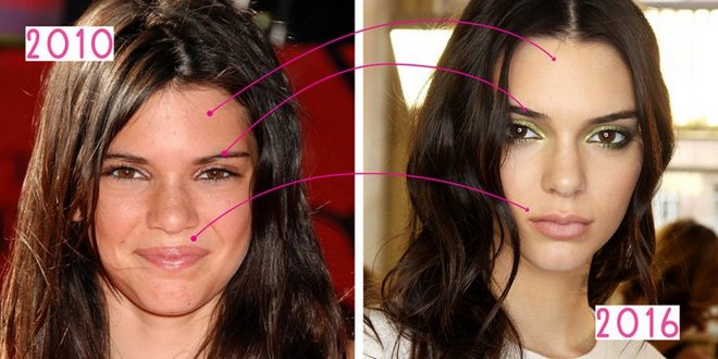 Kendall Jenner. Gambar sebelum dan selepas pembedahan plastik, dalam pertumbuhan penuh. Operasi pada bibir, punggung, kelopak mata, pembetulan hidung