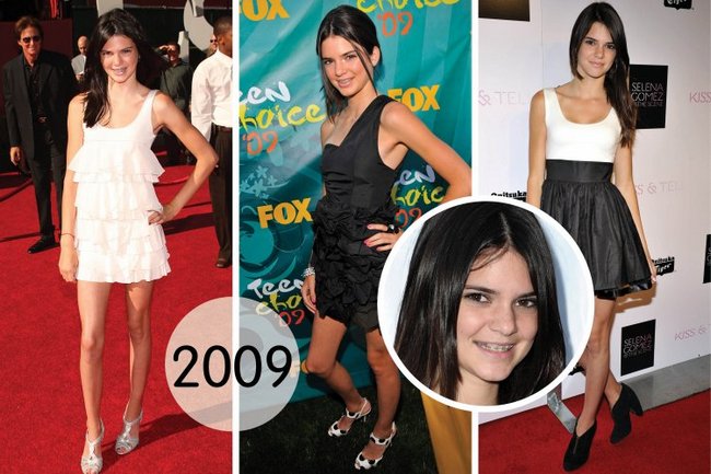 Kendall Jenner. Fotos antes y después de la cirugía plástica, en pleno crecimiento. Operación en labios, glúteos, párpados, corrección de nariz