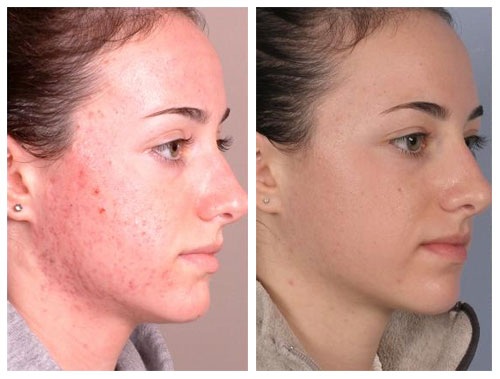 Criomassatge de la cara amb nitrogen líquid: què és, com es fa, indicacions i contraindicacions, resultats. Preu, ressenyes, foto