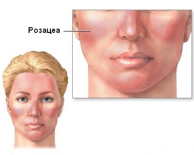 Cryomassage du visage avec de l'azote liquide - qu'est-ce que c'est, comment se fait-il, indications et contre-indications, résultats. Prix, avis, photo