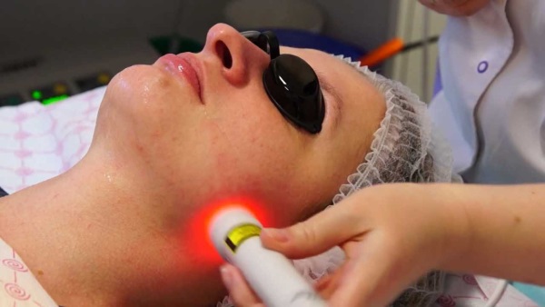 Biorevitalização facial a laser com ácido hialurônico. O que é isso, revisões de cosmetologistas. Preço para 1 procedimento, quantos procedimentos precisam ser feitos