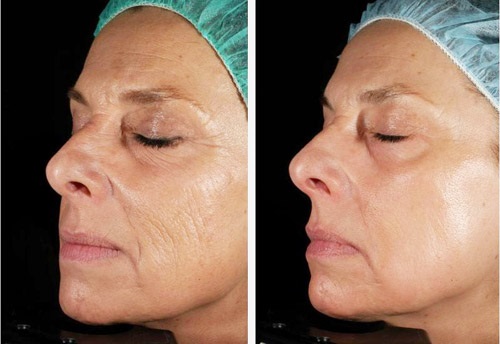Laser nano hóa da mặt, trị rạn da, sẹo, sau mụn. Nhận xét của bác sĩ, chống chỉ định, hậu quả