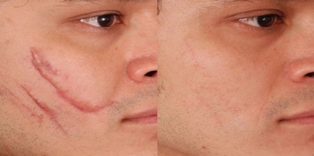 Laser nanoperforatie van het gezicht, striae, littekens, postacne. Recensies van artsen, contra-indicaties, gevolgen