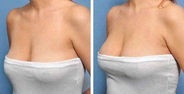 Lipofilling delle ghiandole mammarie. Recensioni di pazienti, chirurghi, prezzo dell'aumento, foto prima e dopo