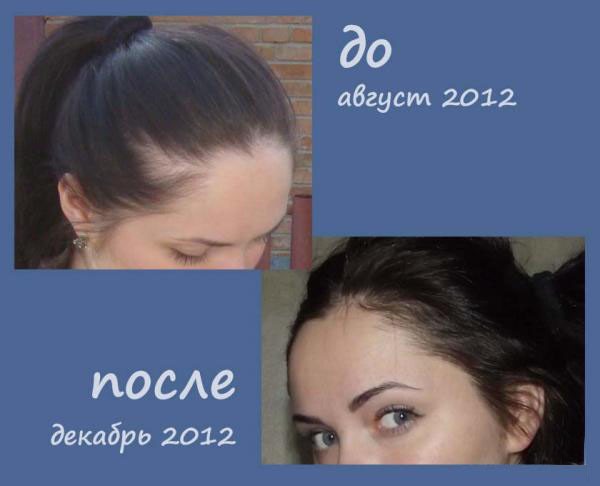 Acide nicotinique pour la croissance des cheveux. Indications, instructions d'utilisation en ampoules, comprimés, masques. Avis des trichologues