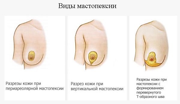 Mammoplasty operation: reduction, augmentation, laser endoscopic, without implants, masculinizing. Stages, rehabilitation and complications