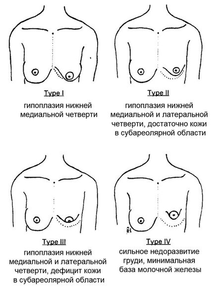 Opération de mammoplastie: réduction, augmentation, endoscopie laser, sans implants, masculinisation. Stades, rééducation et complications