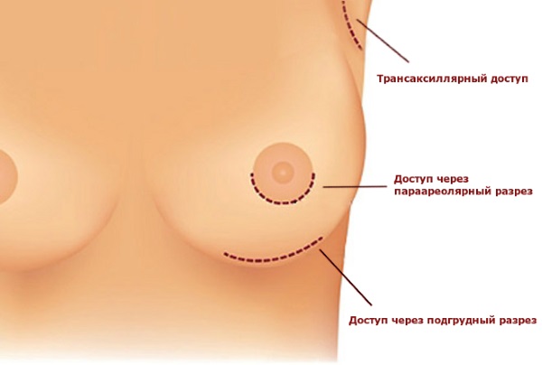 Operasi mamoplasti: pengurangan, pembesaran, endoskopi laser, tanpa implan, maskulinisasi. Tahap, pemulihan dan komplikasi