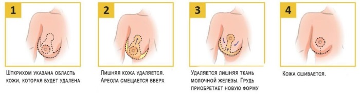 عملية تجميل الثدي: تصغير ، تكبير ، تنظير داخلي بالليزر ، بدون غرسات ، ذكورة. المراحل والتأهيل والمضاعفات