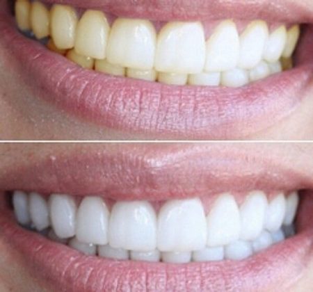 Tires per blanquejar les dents: blancs 3d, Blend a Med, Crest, Rigel, dents avançades, Oral Pro, llum brillant. Preus a les farmàcies