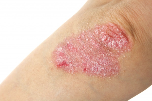Tørr hud på albuene.Årsaker og behandling med folkemedisiner, salver, medisiner i tabletter