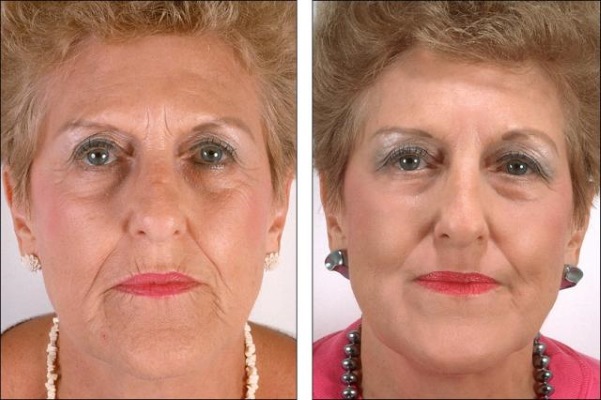 Fadenheben mit 3D-Mesothreads für Gesicht, Lippen, Stirn, Bauch. Vor und nach Fotos, Bewertungen, Preis des Verfahrens