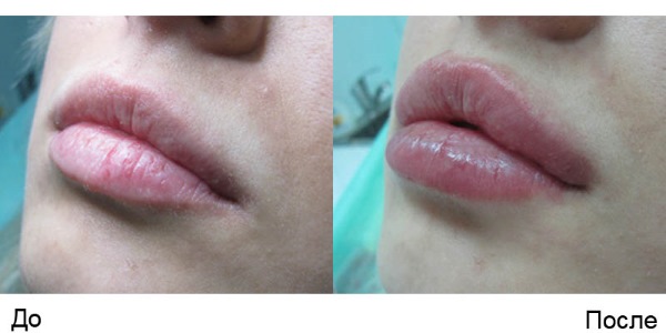 Threadlifting with 3D mesothreads for face, lips, forehead, abdomen. Before and after photos, reviews, price of the procedure