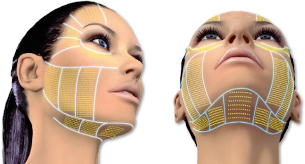 Threadlifting s 3D mesotreovima za lice, usne, čelo, trbuh. Fotografije prije i poslije, pregledi, cijena postupka