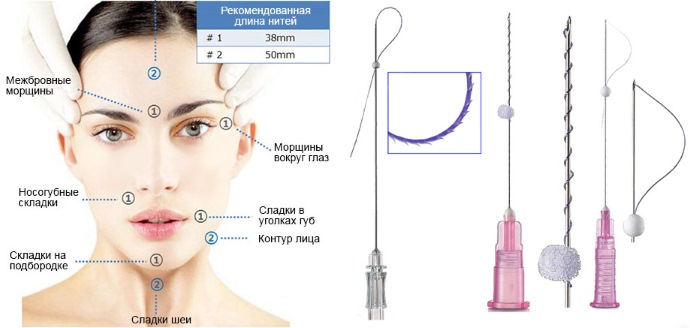 Trådlyftning med 3D mesotrådar för ansikte, läppar, panna, buk. Före och efter bilder, recensioner, pris på proceduren