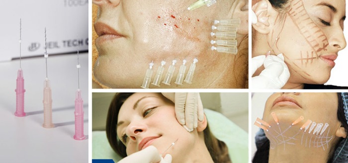Căng da mặt bằng lưới 3D cho khuôn mặt, môi, trán, bụng. Trước và sau hình ảnh, đánh giá, giá của thủ tục