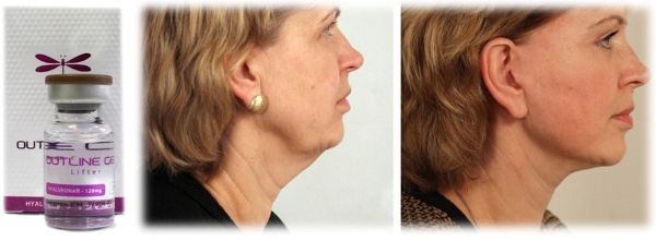 Threadlifting with 3D mesothreads for face, lips, forehead, abdomen. Before and after photos, reviews, price of the procedure