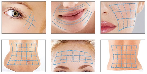Šliapanie nití s ​​3D meziprocesmi na tvár, pery, čelo, brucho. Fotky pred a po, recenzie, cena zákroku