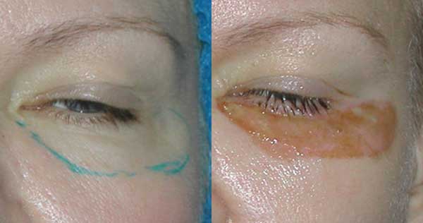Nicht-chirurgische Blepharoplastik der oberen und unteren Augenlider: kreisförmig, Laser, Hardware. Preise, Rehabilitation und mögliche Komplikationen
