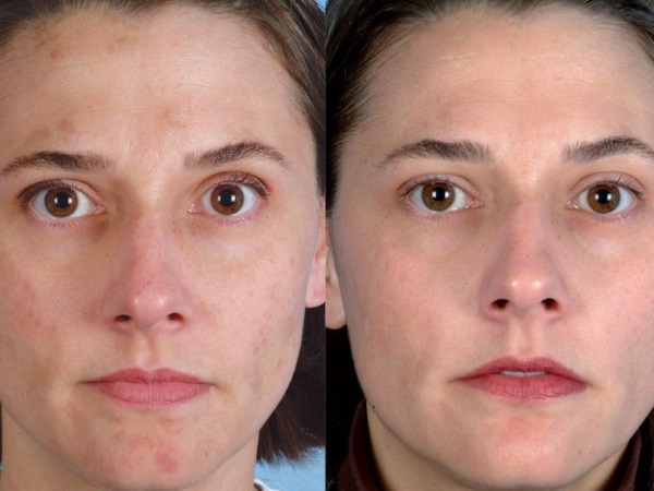 تقشير الوجه الماسي - ما هو ، الأجهزة ، الكريمات للتقشير الدقيق الأنزيمي. سعر الإجراء