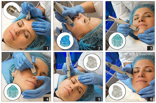 تقشير الوجه الماسي - ما هو ، الأجهزة ، الكريمات للتقشير الدقيق الأنزيمي. سعر الإجراء