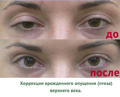 Icke-kirurgisk blefaroplastik i övre och nedre ögonlocken: cirkulär, laser, hårdvara. Priser, rehabilitering och eventuella komplikationer