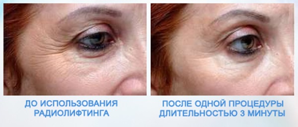 Ikke-kirurgisk blefaroplastikk i øvre og nedre øyelokk: sirkulær, laser, maskinvare. Priser, rehabilitering og mulige komplikasjoner