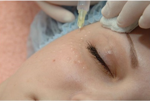 Ikke-kirurgisk blefaroplastikk i øvre og nedre øyelokk: sirkulær, laser, maskinvare. Priser, rehabilitering og mulige komplikasjoner