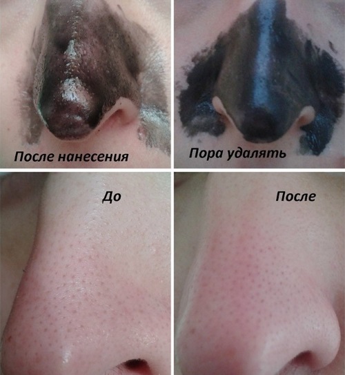 Μαύρος πηλός για πρόσωπο, μαλλιά, δέρμα. Ιδιότητες και εφαρμογή: μάσκες για ακμή, σπυράκια, κυτταρίτιδα, καθαρισμός, περιτύλιξη αδυνατίσματος