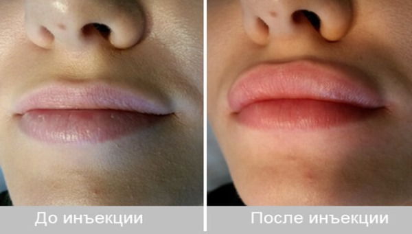 Vulstoffen in de nasolabiale plooien, onder de ogen, in de lippen, in de jukbeenderen. Correctie van de neus, nasolacrimale groef. Gezichtscontouren