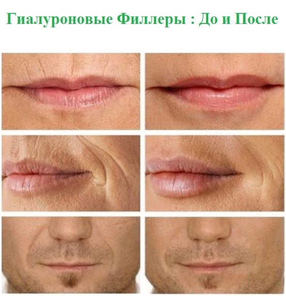 Vulstoffen in de nasolabiale plooien, onder de ogen, in de lippen, in de jukbeenderen. Correctie van de neus, nasolacrimale groef. Gezichtscontouren