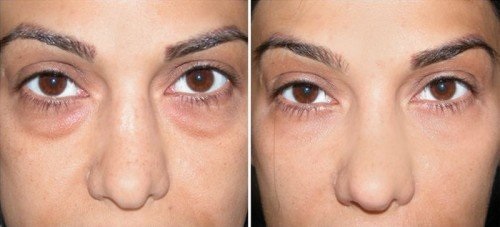Хепаринска маст за лице у козметологији. Особине и примена код бора, модрица, врећица, натечености испод очију
