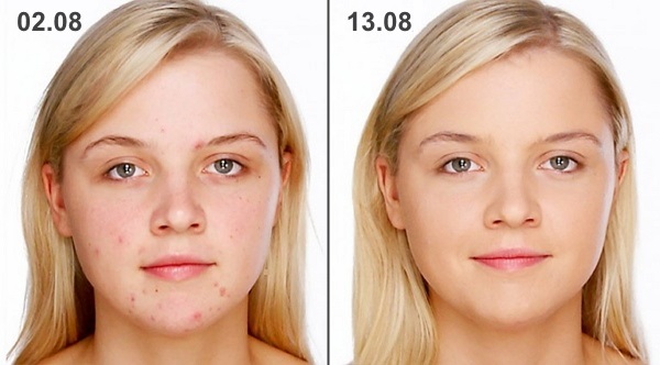Ungüento de heparina para el rostro en cosmetología. Propiedades y aplicaciones para arrugas, hematomas, bolsas, hinchazón debajo de los ojos.