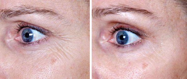 Heparinsalbe gegen Falten unter den Augen. Gebrauchsanweisung, Anwendung, Bewertungen von Kosmetikerinnen