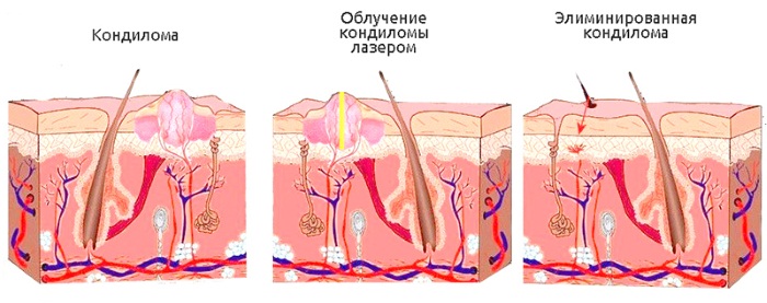 วิธีการกำจัด papillomas ในร่างกายด้วยยาพื้นบ้านวิธีการผ่าตัด