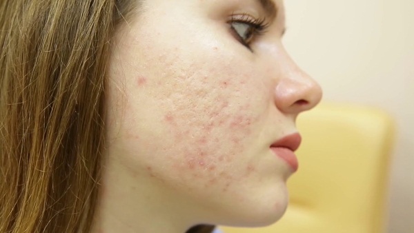 Comment se débarrasser des cicatrices d'acné à la maison. Pommades, crèmes, remèdes populaires