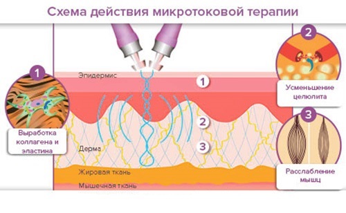 Hoe rimpels op het voorhoofd, onder de ogen, nasolabiaal, boven de bovenlip, tussen de wenkbrauwen, in de nek, tussen de wenkbrauwen, nabootsen