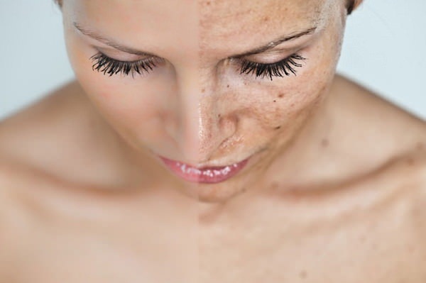 Laser phân đoạn trẻ hóa da mặt, da toàn thân. Clear Brilliant, Hoa Kỳ. Ưu nhược điểm, đánh giá